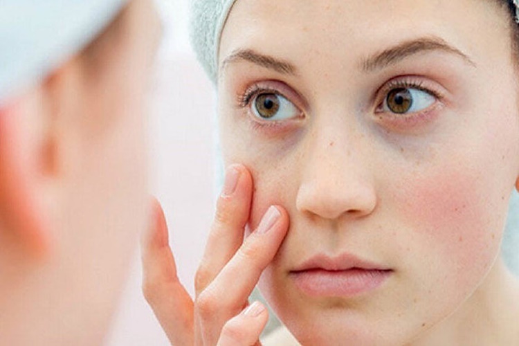 Lupus Bulaşıcı Mıdır?