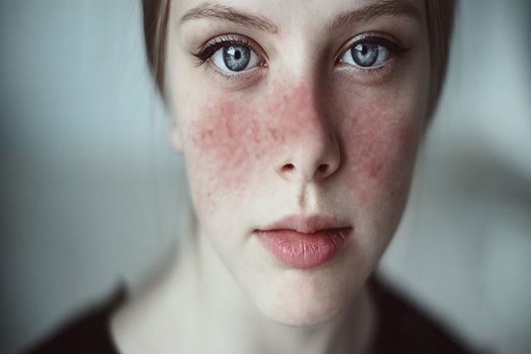 Lupus Geçer Mi?