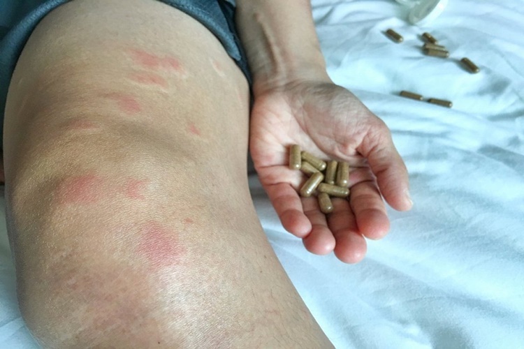 Lupus Hastalarının Çocuğu Olur Mu?