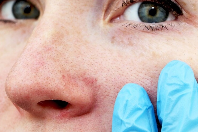 Lupus Hastalığı Neden Olur?