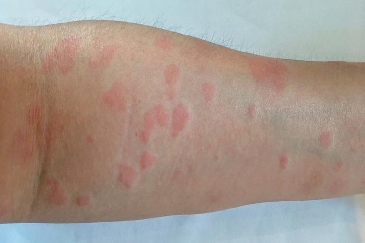 Lupus Hastası Engelli Raporu Alabilir Mi?