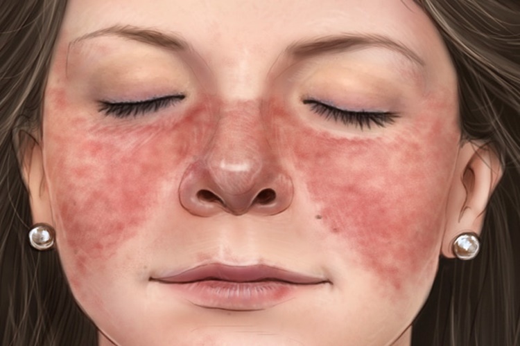 Lupus Nasıl Bir Hastalıktır?
