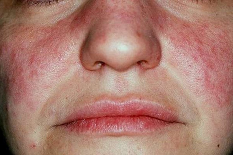 Lupus Polisliğe Engel Mi?