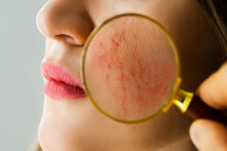 Lupus Tedavisi Var Mı?