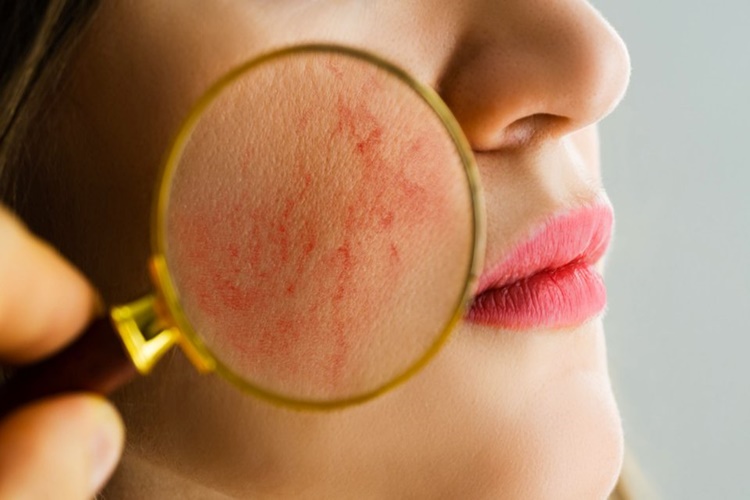  Lupus Testi Nasıl Yapılır?