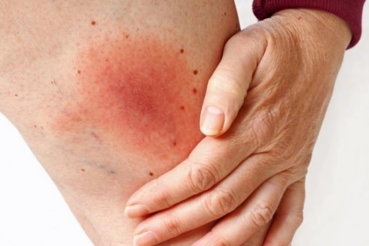 Lyme Belirtileri Nelerdir?