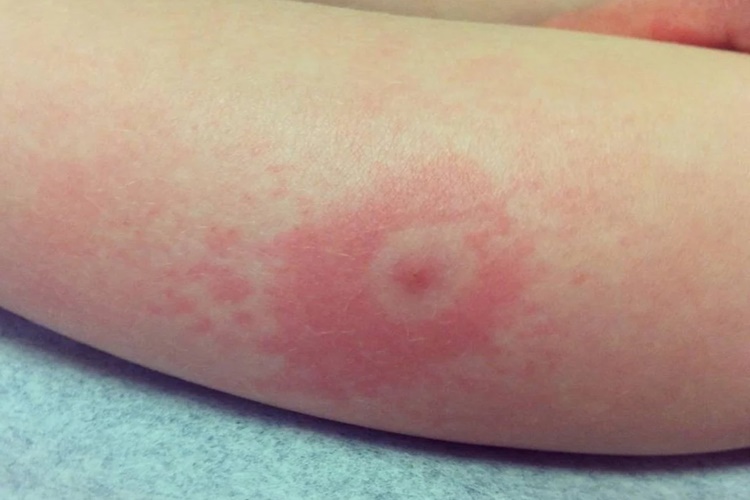 Lyme Enfeksiyonu Nasıl Geçer?