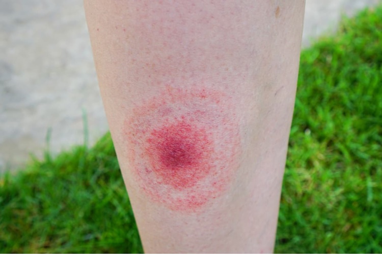 Lyme Etkeni Nedir?