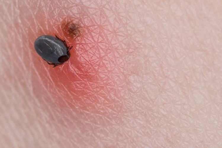 Lyme Hastalığı Nedir?