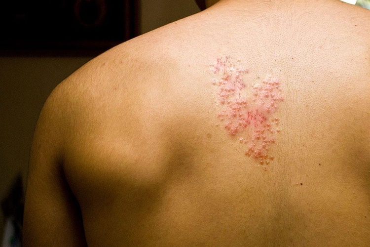 Lyme Hastalığı Tedavisi Nasıldır?