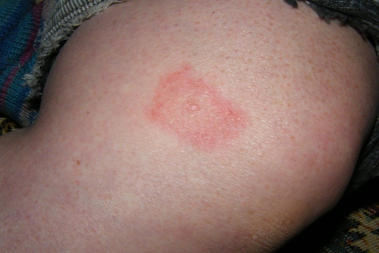 Lyme Hastalığı Testi Nedir?