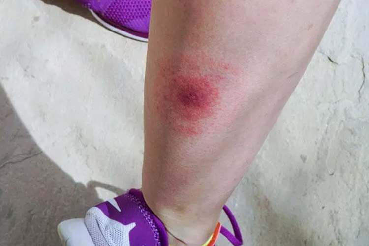 Lyme Öldürür Mü?