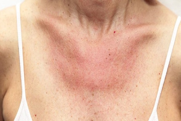 Madecassol Tahrişe İyi Gelir Mi?