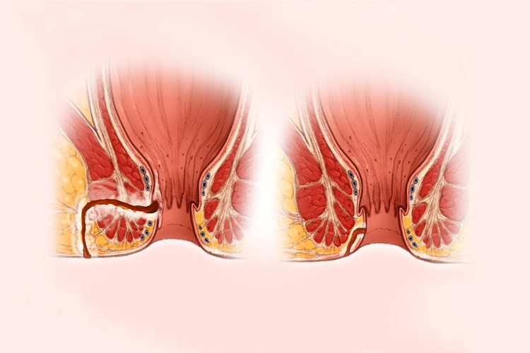 Makat Apsesi Ameliyatı Sonrası Pansuman Nasıl Yapılır?
