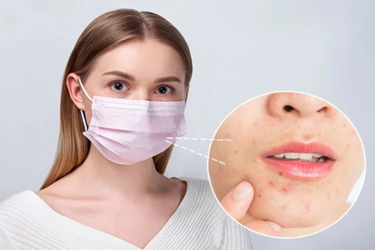 Maske Takmak Sivilce Yapar Mı?