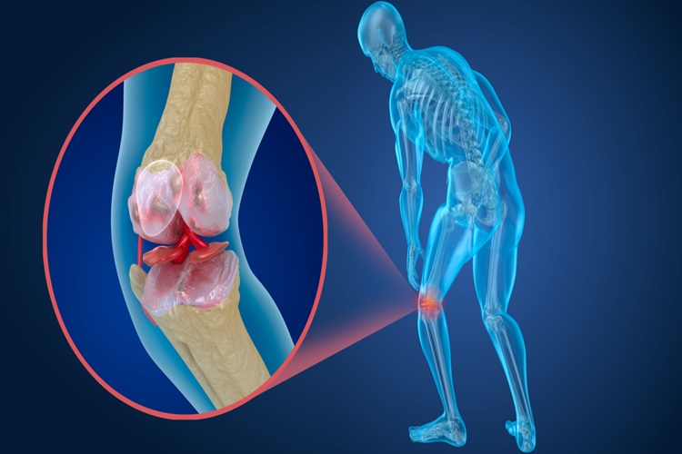 Menisküs Nedir?