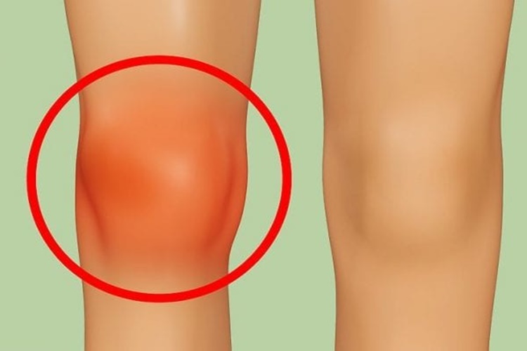 Menisküs Yırtığı Ödem Yapar Mı?