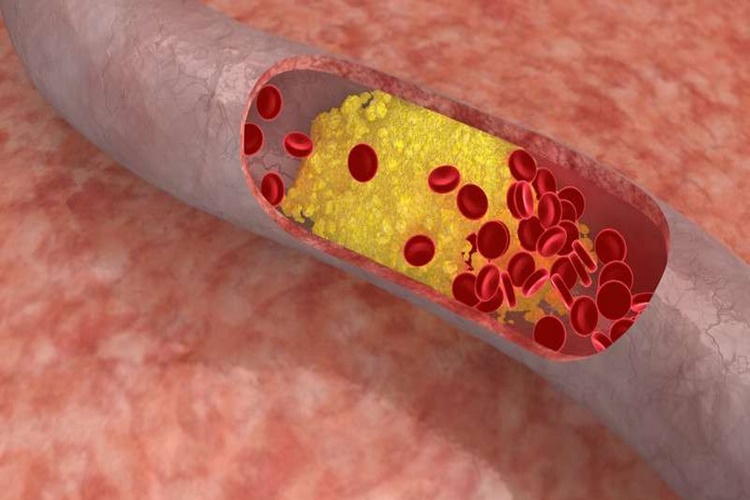 Mercimek Kolesterolü Yükseltir Mi?