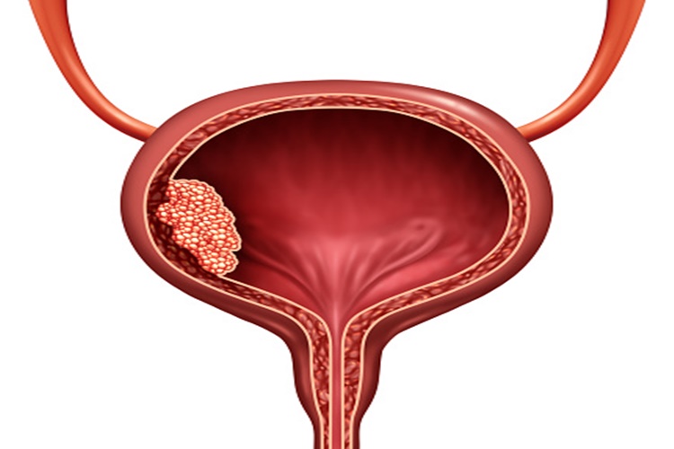 Mesane Taşları Nasıl Düşürülür?