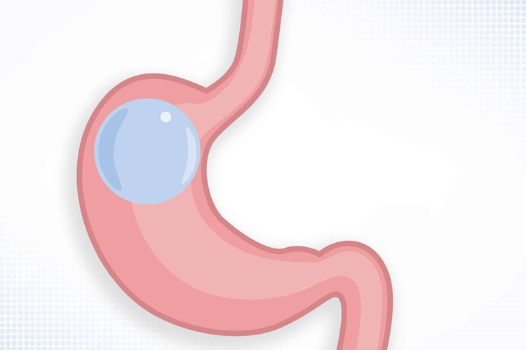 Mide Balonu Nedir?