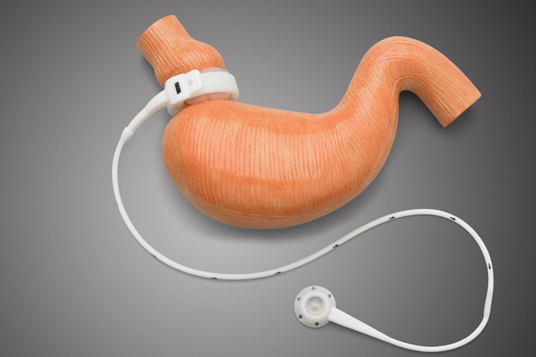 Mide Bandı İle Zayıflama Nedir?