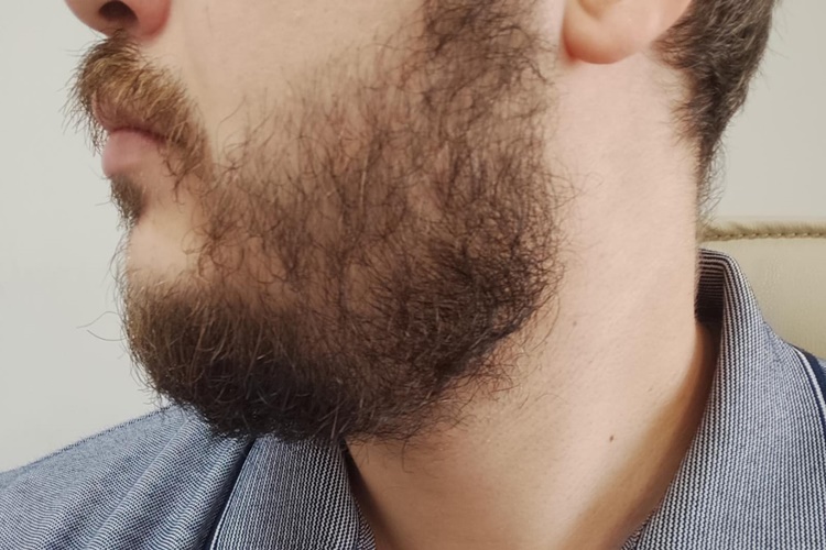 Minoxidil 5 Sakal Çıkarır Mı?