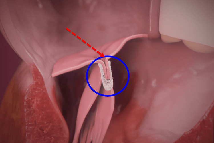 Mitral Yetmezlik Belirtileri Nelerdir?