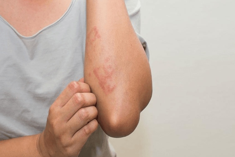 Momecon Losyon Kaç Dakika Bekletilir?