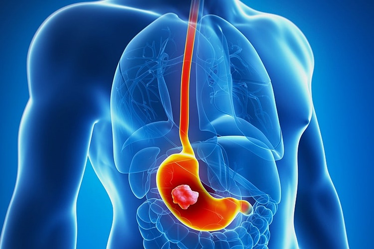 Nexium 40 Mg Mide Ağrısına İyi Gelir Mi?