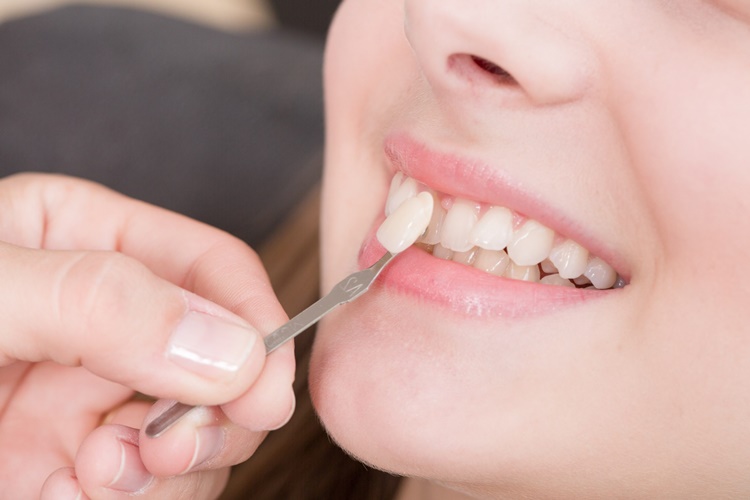 Ön Diş Dolgusu Düşer Mi?