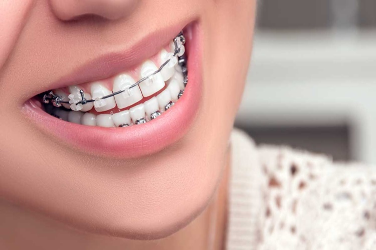 Ortodonti Kaç Yıl Sürer?