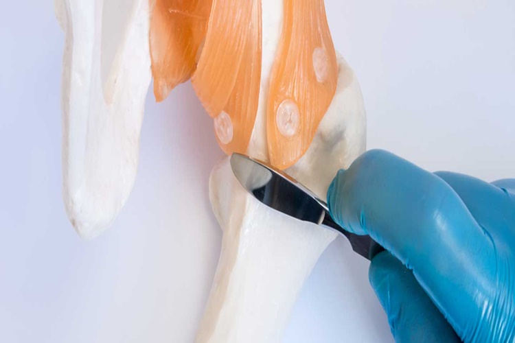 Osteomyelit Tedavisi Var Mı?
