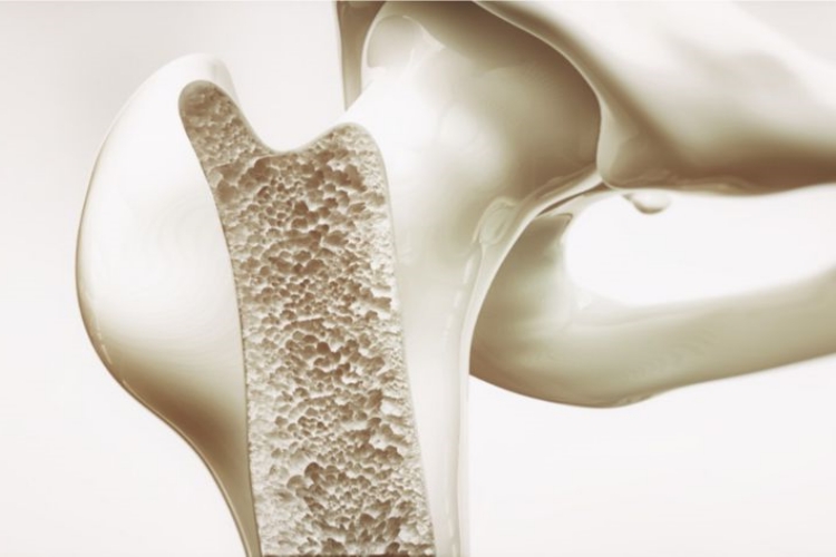 Osteoporoz Hastalığı Genetik Midir?