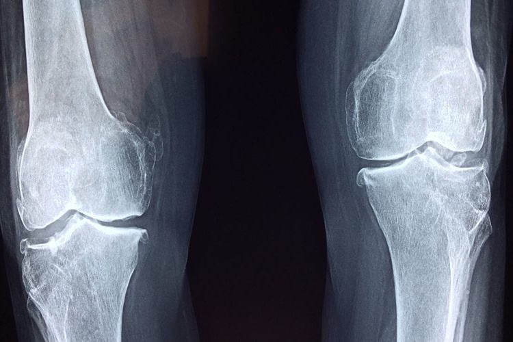 Osteoporoz Nasıl Tüketilir?
