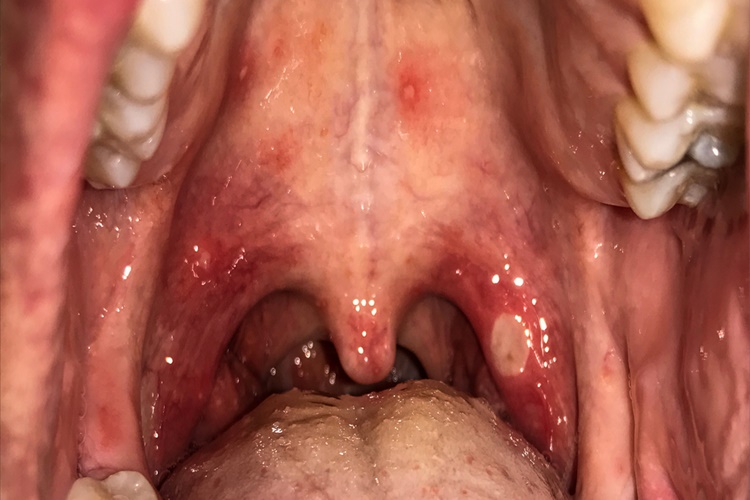 Palatum Damak Nedir?