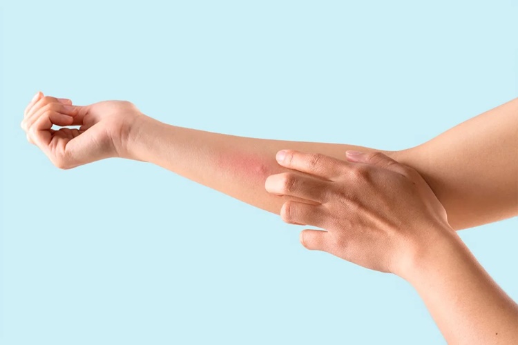 Paraben Alerjisi Belirtileri Nelerdir?