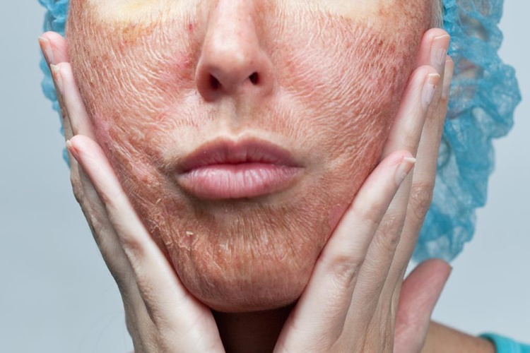 Peeling Cildi Beyazlatır Mı?