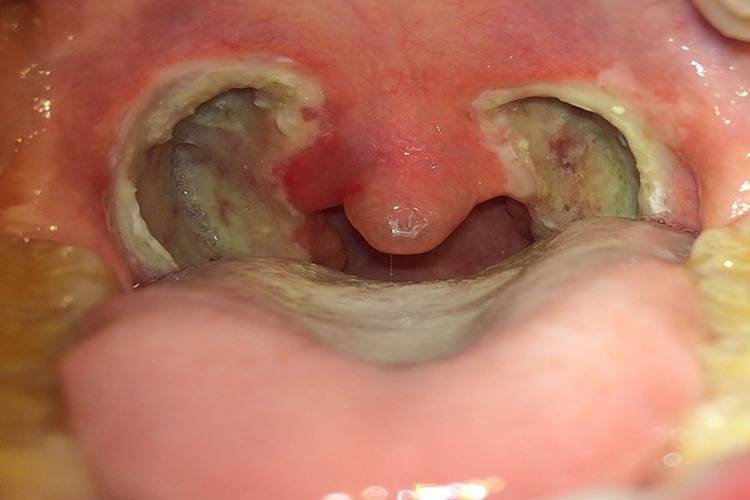 Pfapa Sendromu Nedir?