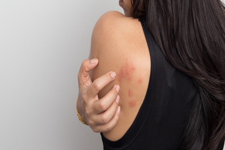 Polen Alerjisi Vücutta Kaşıntı Yapar Mı?