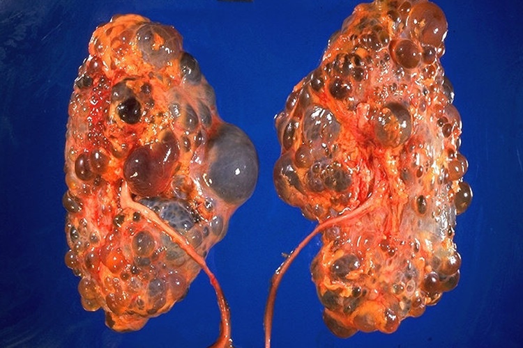 Polikistik Böbrek Hastalığı Neden Olur?