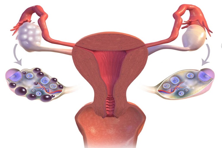 Polikistik Over Sendromu Doğuştan Mı?