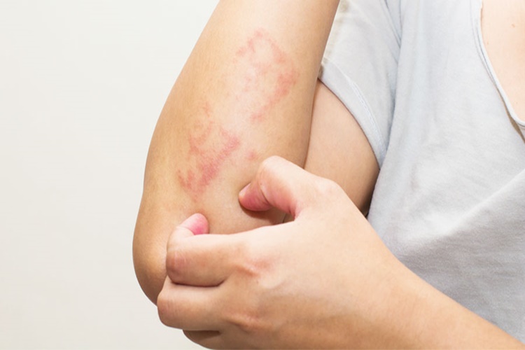 Propolis Egzamaya Sürülür Mü?