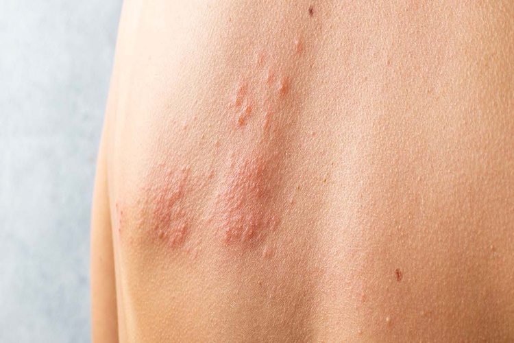 Propolis Kaşıntıya İyi Gelir Mi?
