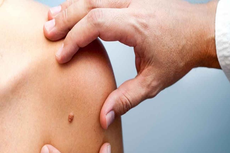 Propolis Siğile Sürülür Mü?