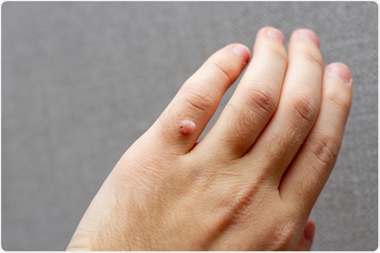 Propolis Siğillere İyi Gelir Mi?