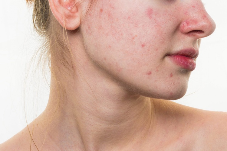 Propolis Sivilce İzlerine İyi Gelir Mi?