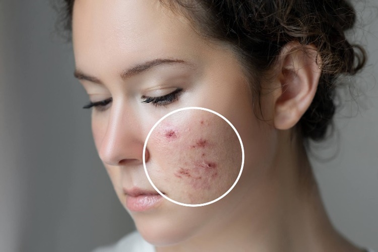 Propolis Sivilceye İyi Gelir Mi?