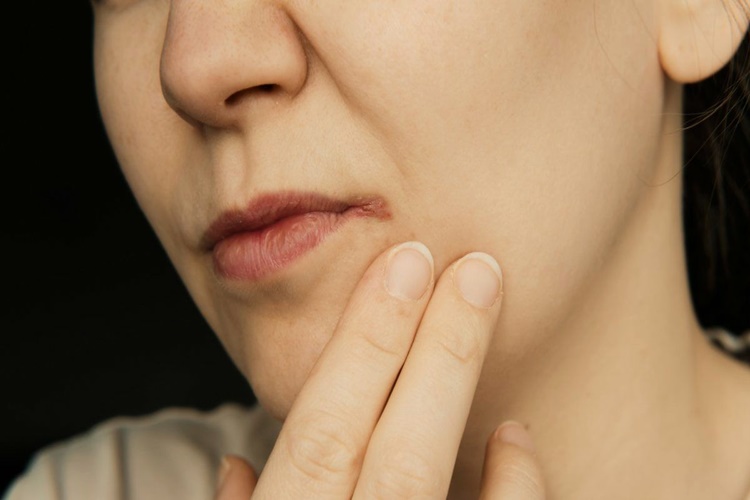 Propolis Uçuğa Sürülür Mü?