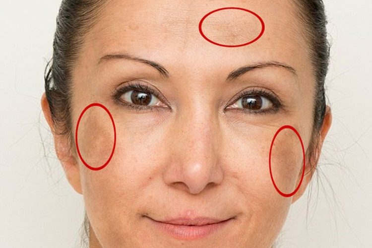 Propolis Yüzdeki Lekelere İyi Gelir Mi?
