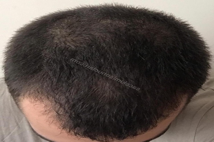 Proscar Saç Çıkarır Mı?